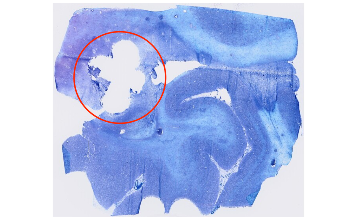 Post_Biopsy