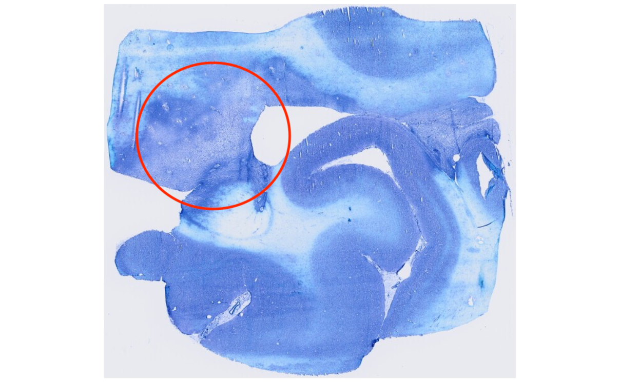 Pre_Biopsy